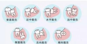  长智齿的民间说法与风水解读